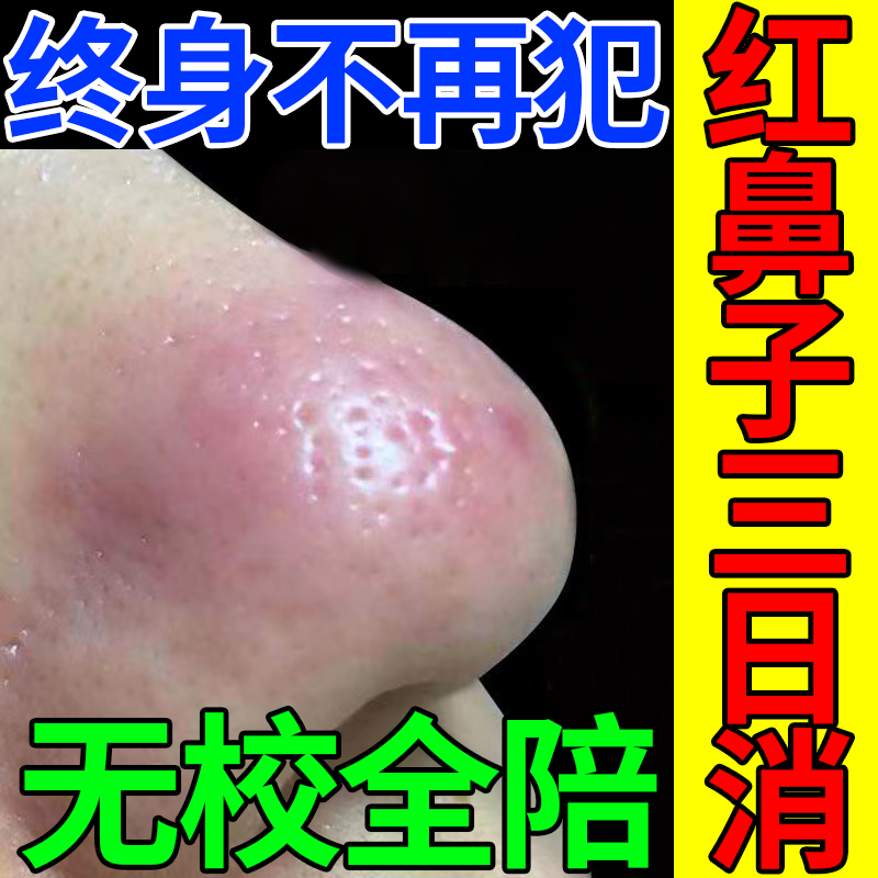 酒渣鼻特效根i治药修复红鼻子专用酒槽鼻药i膏螨虫