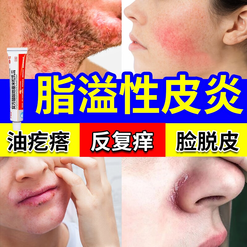 复方醋酸地塞米松乳膏 脂溢性皮炎用药膏面部脸鼻子周围下巴红肿硬