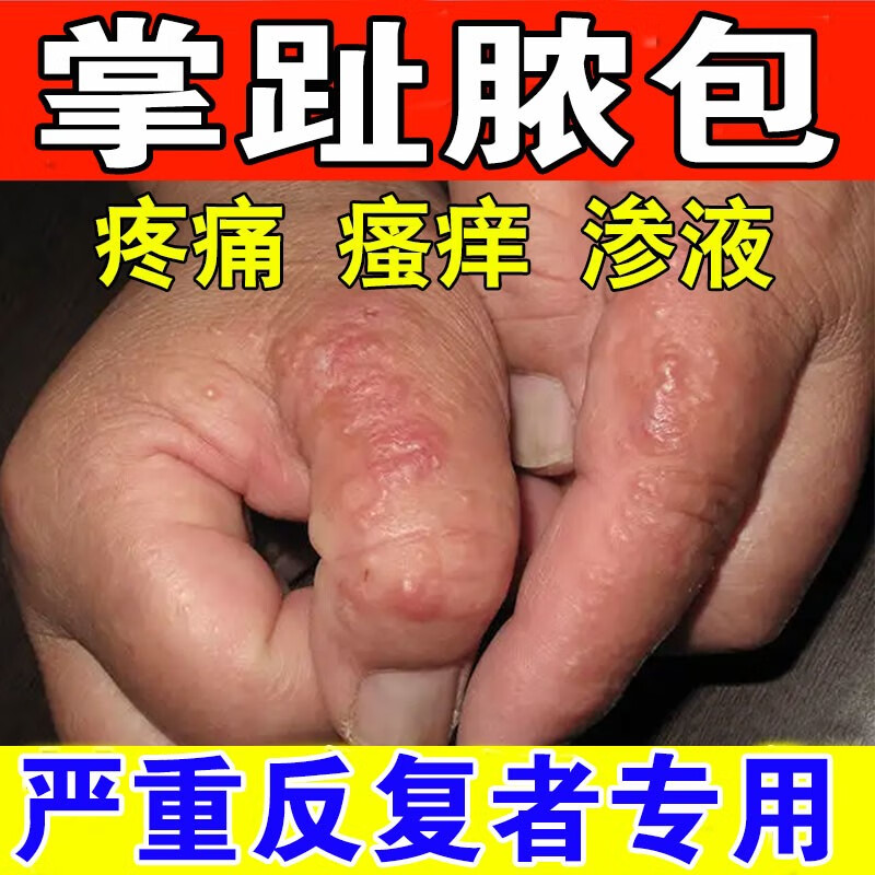 鹅掌风手癣真菌感染水泡丘疹止瘙痒干裂脱皮手足藓皮外用药i膏 1盒装