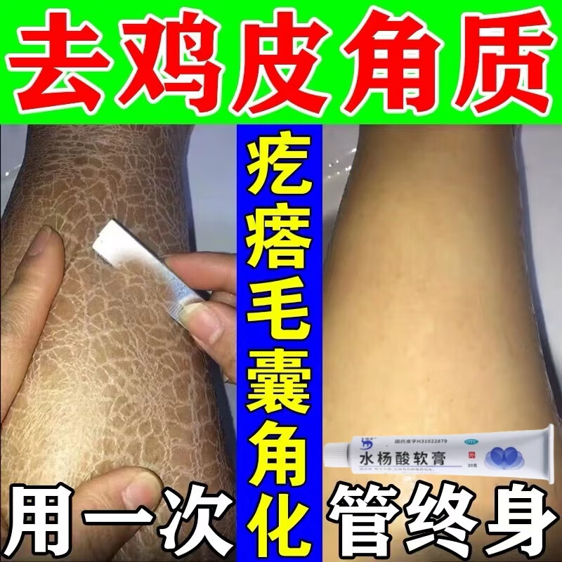 鸡皮肤疙瘩毛囊角化症专用药去鸡皮肤去除神器毛囊角质疙瘩大腿特傚药