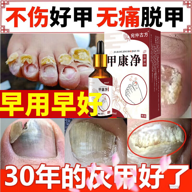 翰鸥斐甲家乐凤仙花抑i菌液甲易康环吡i酮胺乳膏脚指甲发黄变灰甲净