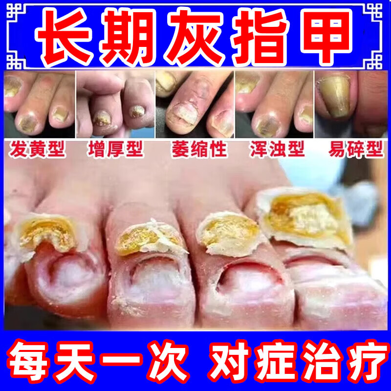 治灰指甲的药脚趾甲 灰指甲专用膏药膏指甲真菌感染脱甲增厚变色坏甲