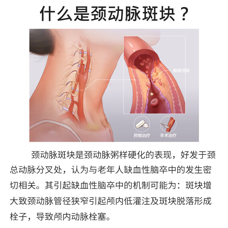 北京同仁堂颈动脉血管斑块堵塞疏通颈血管非药穴位贴辅助治疗颈动脉斑块清理血管堵塞狭窄疏通脑供血不足头晕 买二送一【三盒 周期装】
