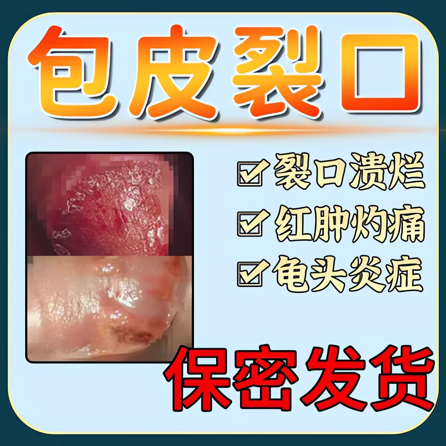 念珠菌男性包皮炎症龟头炎专用非喷剂药软膏红点裂口男性私处包皮念珠