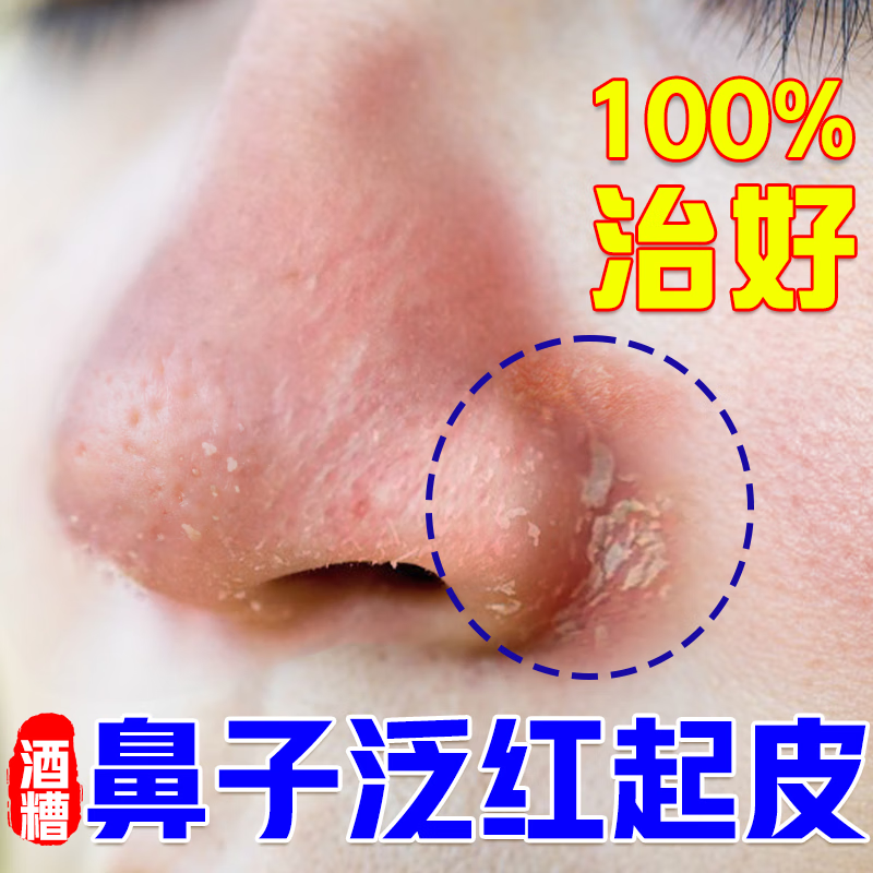 dinofen官方每奈祖郎中鼻子两侧发红脱皮鼻翼两边泛红干燥 治红 治红