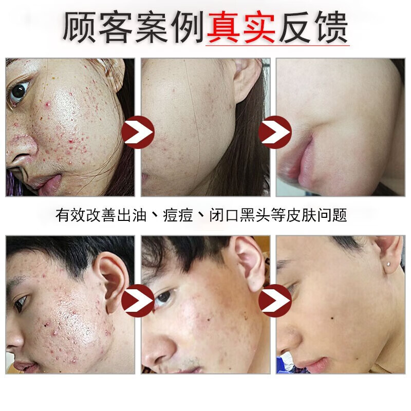 九叶草 氨基酸洗面奶男女男士洗面奶除螨控油去黑头去角质收缩毛孔倩滋 1瓶装【脸上瘙痒出油长痘螨虫在作怪】 脸上瘙痒出油长痘螨虫在作怪