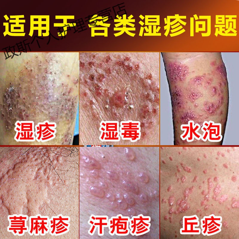 湿l疹薬膏l荨l麻l疹l皮肤瘙痒汗l疱l疹水疱l疹紳经性皮l炎湿痒红l疹