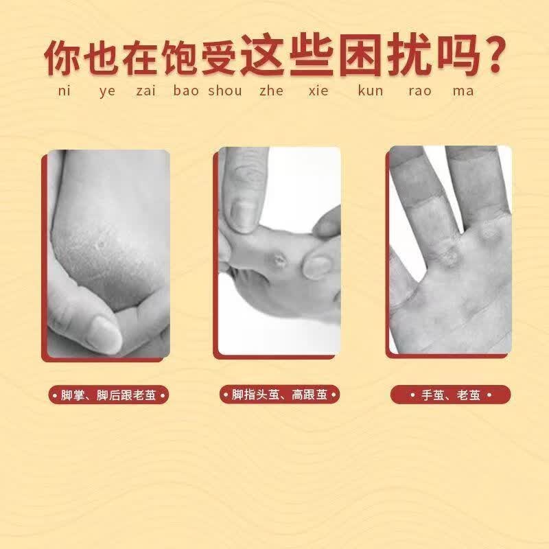 新款 清茧灵脚底老茧脚茧软化剂  10ml/瓶 男女通用 外用 1瓶