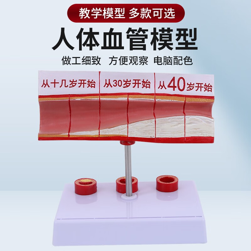 血管梗塞 血管解剖模型 人体血管模型动脉血管阻塞变化演示教学模型