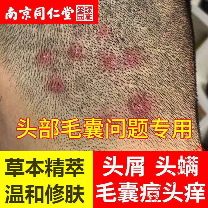 毛囊皮炎洗发水去屑控油脂溢性头皮屑护理除头皮螨虫痘痘毛炎宁洗发水