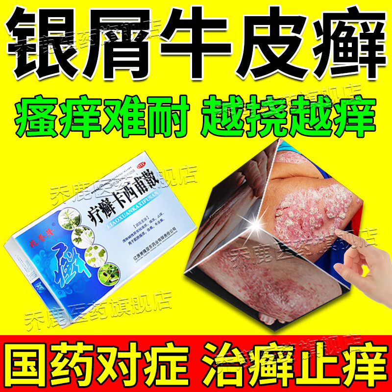 牛皮癣药疗癣卡西甫散 治疗牛皮癣成人专用顽固痒牛皮癣银屑病进口
