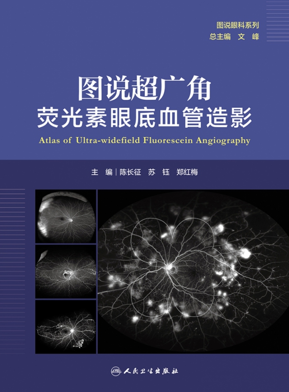 图说超广角荧光素眼底血管造影（图说眼科系列）