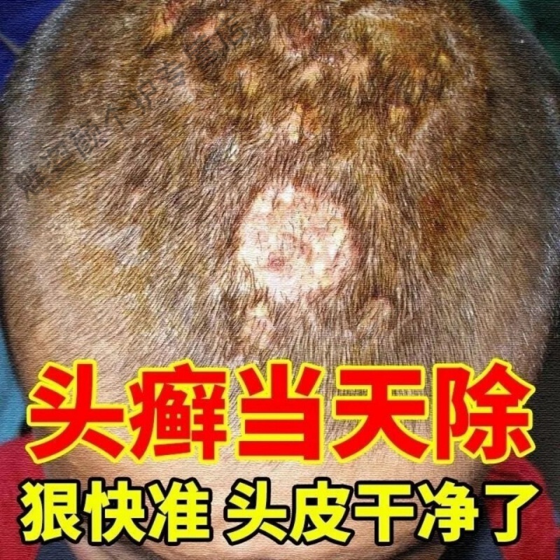 顽癣止痒膏 对毛炎囊牛皮头皮生癣脚气甲头x癣 牛皮x癣头皮脂溢性皮p