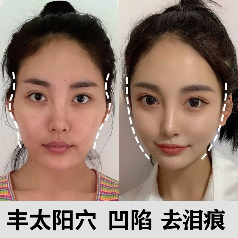 【中山大学联合研制】丰太阳穴丰泪沟填充淡化泪沟凹陷修复脸部填充去