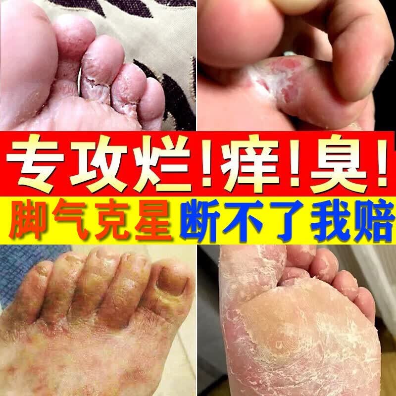清可颜南京同仁堂狼毒脚气喷剂抑菌膏脱皮汗脚臭脚痒去脚丫烂足喷雾套装使用感如何?