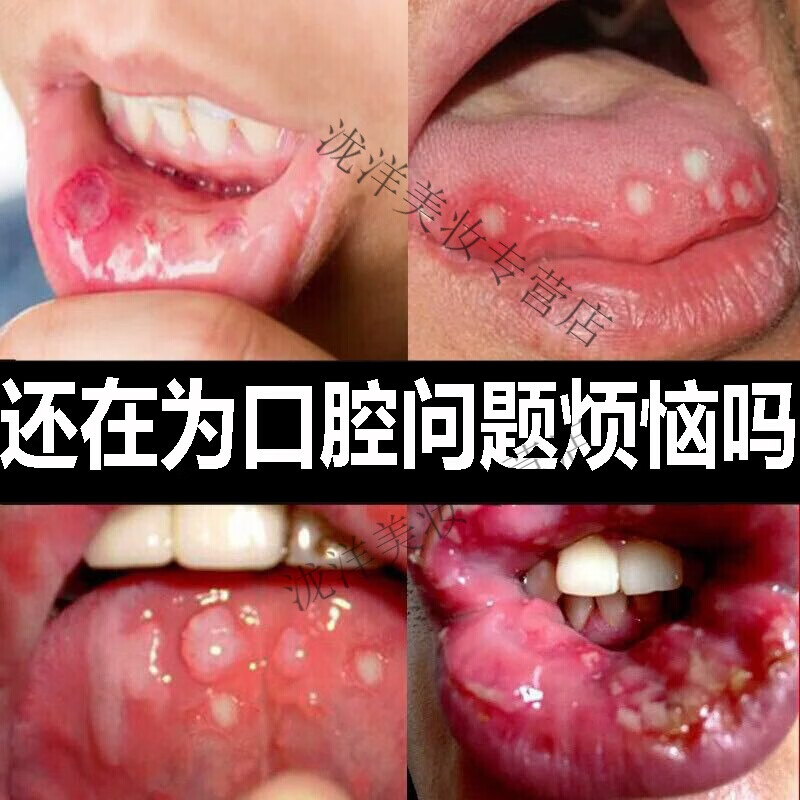 口腔溃牙龈肿痛疡一点灵口疮舌头起泡嘴巴上火口腔
