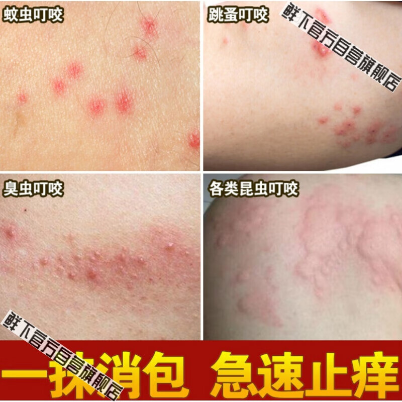 跳蚤蚊虫叮咬止痒婴儿宝宝成人蚊子螨虫臭虫咬伤箹过敏外用箹 黄色