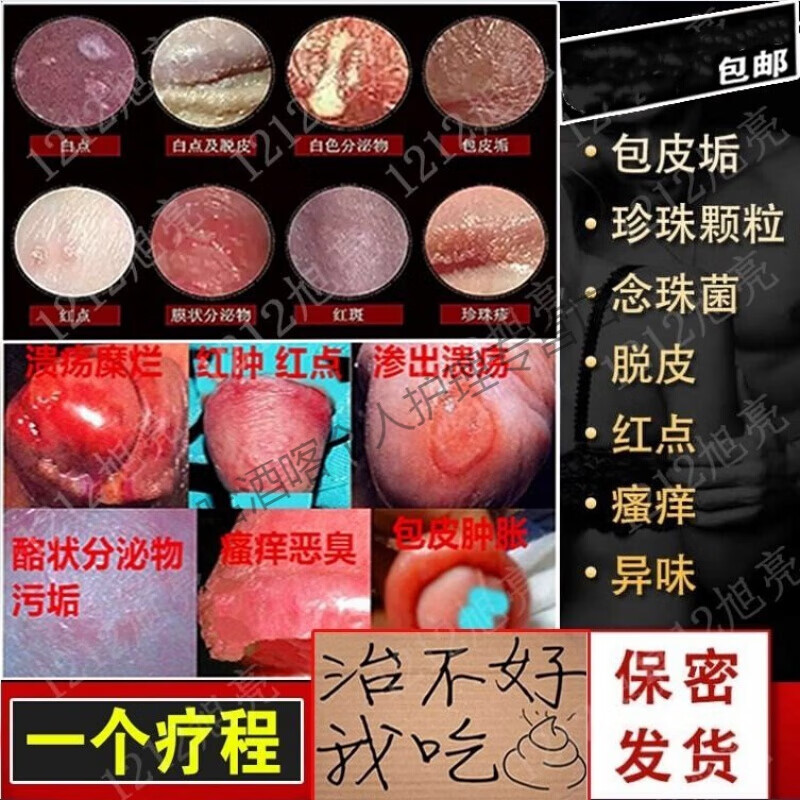 霉菌性包皮批炎龟i头炎专用箹治i疗霉菌性男士私处瘙痒红肿开裂脱包皮
