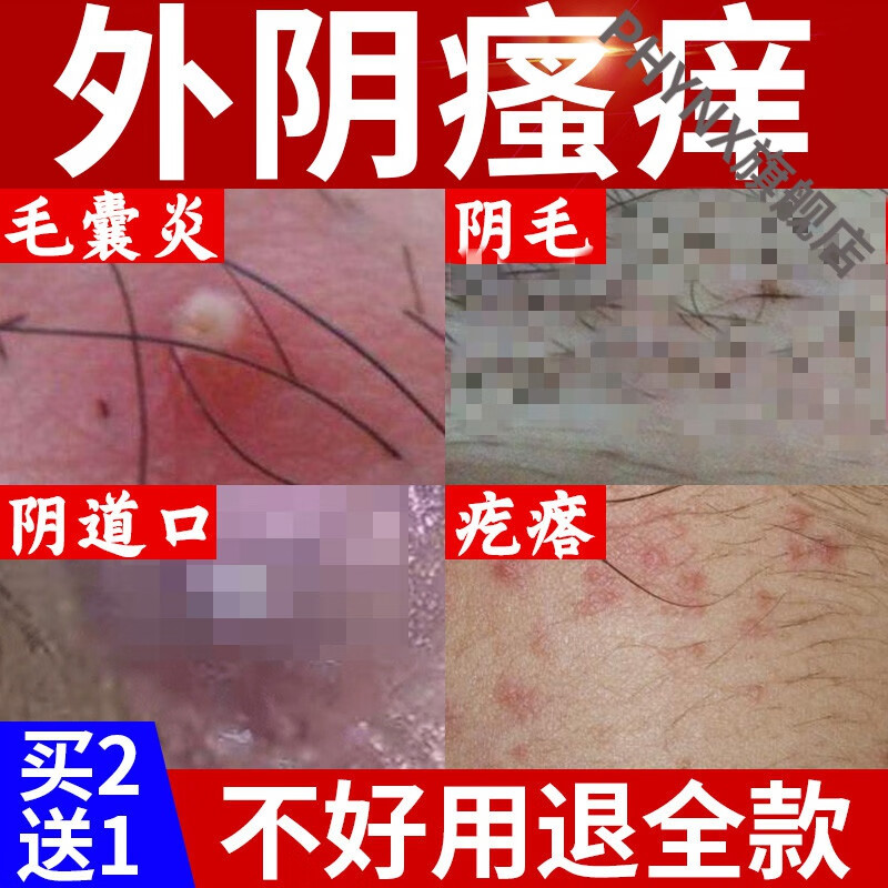 外阴下体膏炎瘙痒私处下面痒阴l毛毛囊男女专用止痒外用箹白斑 一盒装