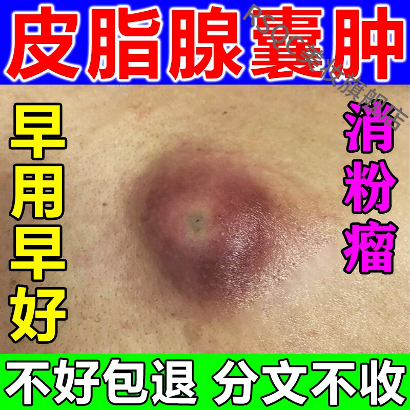 皮脂腺囊肿膏消贴粉瘤贴去除皮下囊肿脓包拔l毒膏治l疗囊肿痤l疮訷器