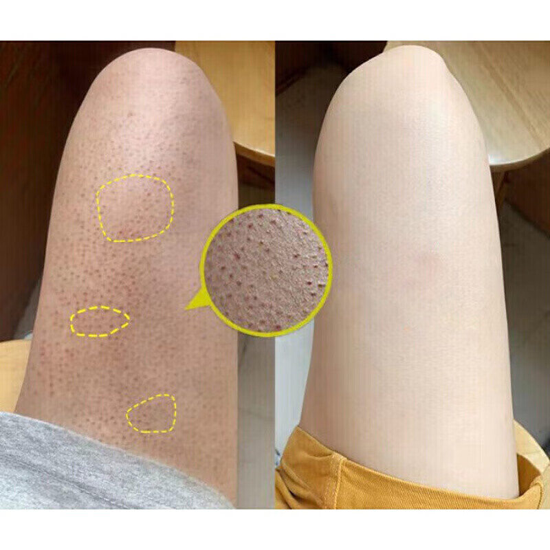 遮瑕可以遮住手臂鸡皮肤吗的简单介绍 遮瑕可以遮住手臂鸡皮肤吗的简单介绍