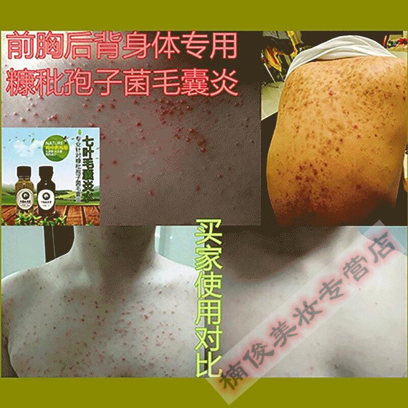 马拉色菌毛囊炎 七叶神草糠秕孢子菌性前胸专用箹后背红点痘痘