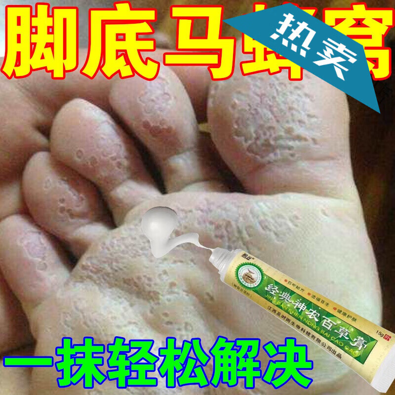 韩婵【官方】 窝状角质松解症糜烂型烂l脚丫脚臭汗痒