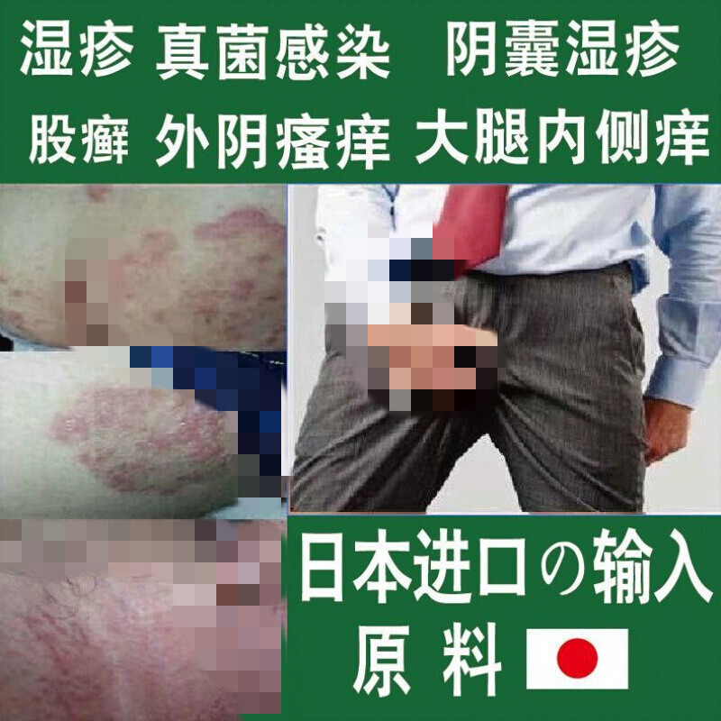 日本皮肤瘙痒皮l炎湿l疹湿毒癣红l斑牛皮痒癣手足体股l癣皮肤瘙痒疥l