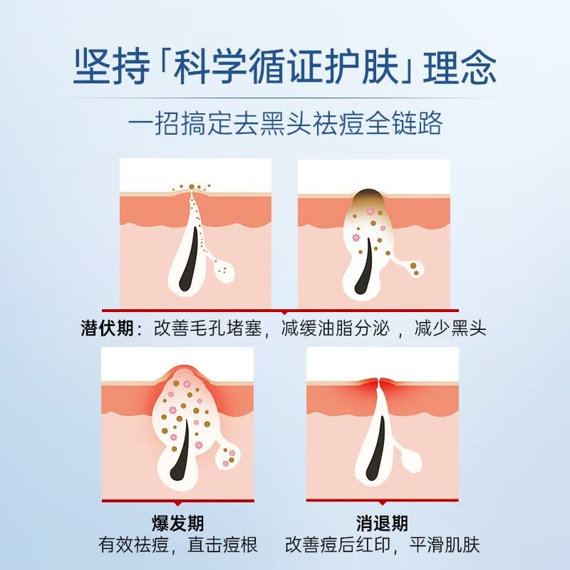 质润壬二酸15%凝胶祛痘祛痘印去黑头粉刺闭口收缩毛孔控油壬二酸乳膏 【祛痘入门装】正装 15g