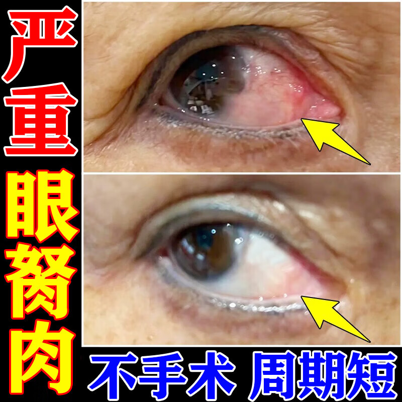 熊胆滴眼液 去翼状胬肉胬肉攀睛去翳明目眼睛浑浊发痒有异物感眼药水