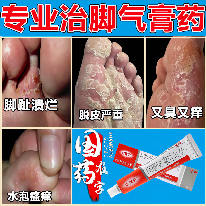 达克宁脚气药 脚气药止痒脱皮烂脚丫真菌感染止痒治脚气脚上起水泡