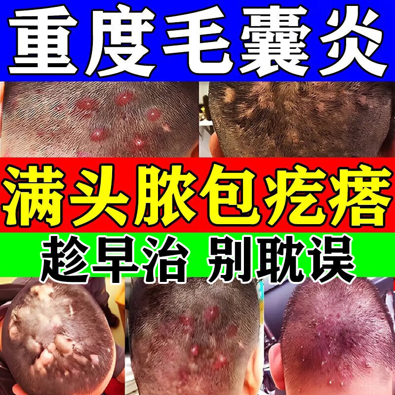 头皮毛囊炎专用特效药头上长疙瘩脓包头皮发痒长红痘痘刺痛毛囊堵塞