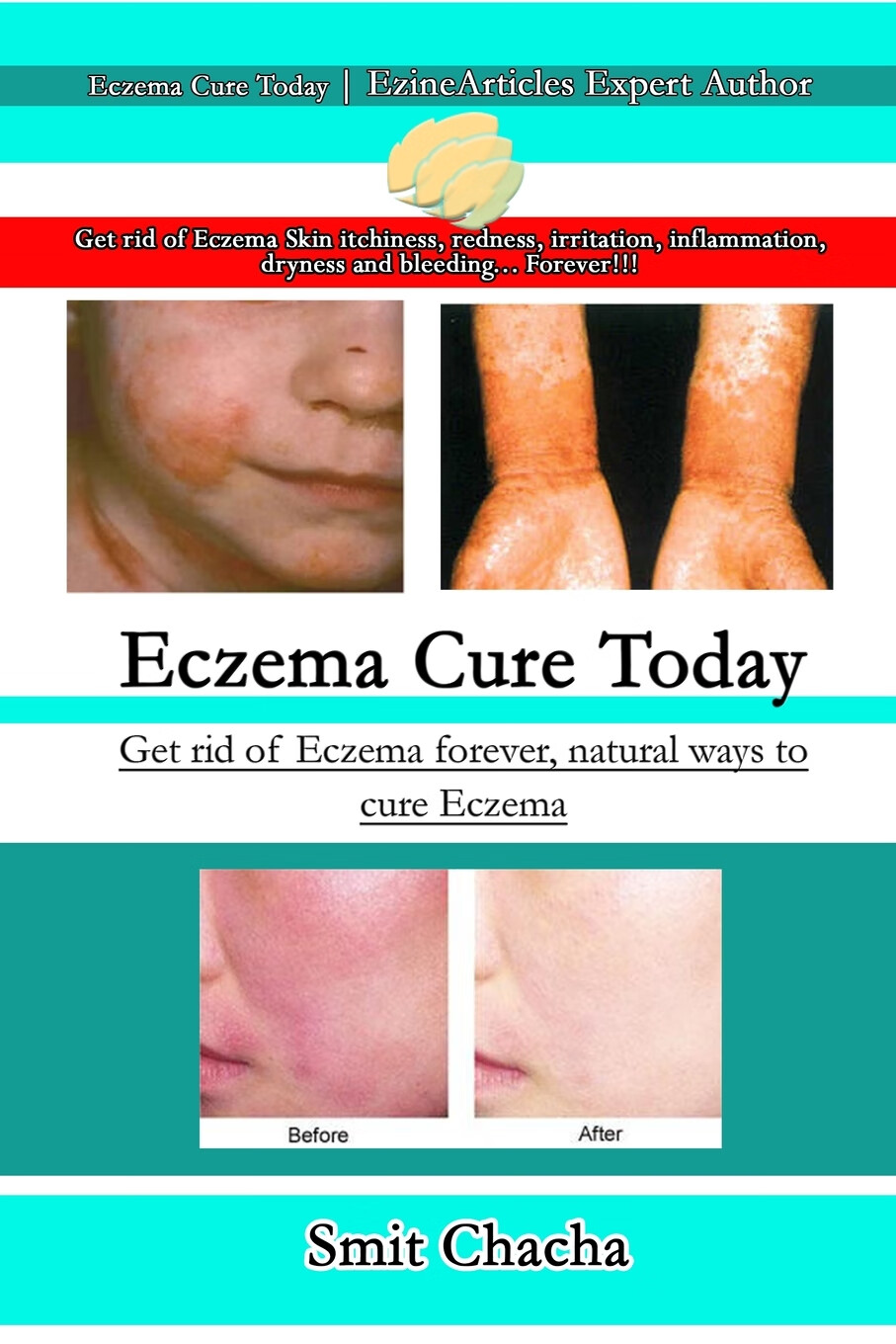 【预售 按需印刷】eczema cure today - get rid of eczema forever