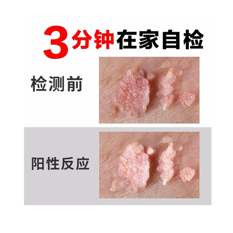 维真园 醋酸白抑菌液30ml 尖锐湿疣检测液醋酸白试验hpv检测测试液