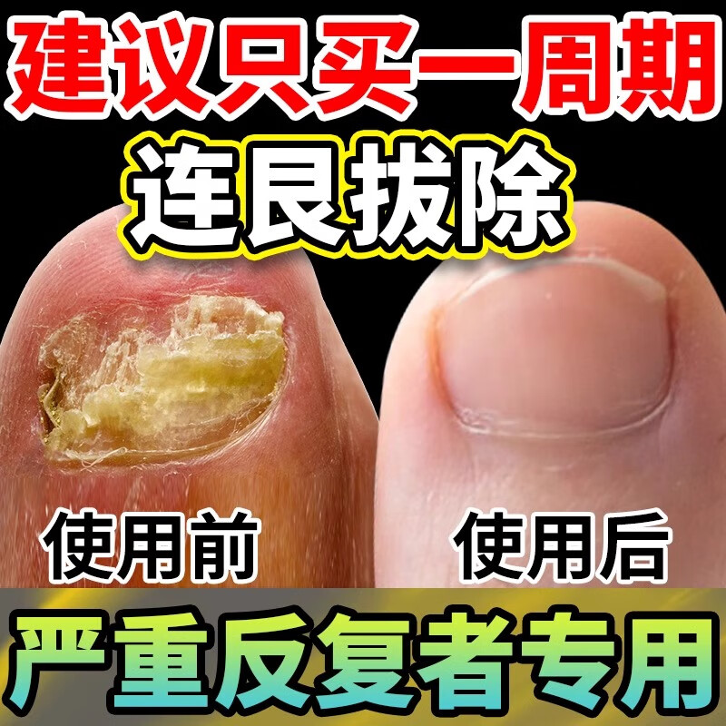 pomada de la campana灰指甲专用特傚效药艮治甲正沟品炎真菌感染甲