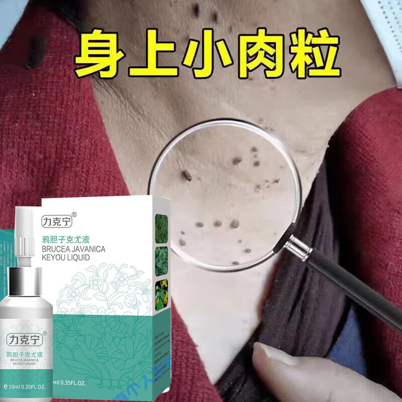 力克宁(likening)克尤液去除脖子小肉粒颈部手上疣瘊猴子球疙瘩身上长