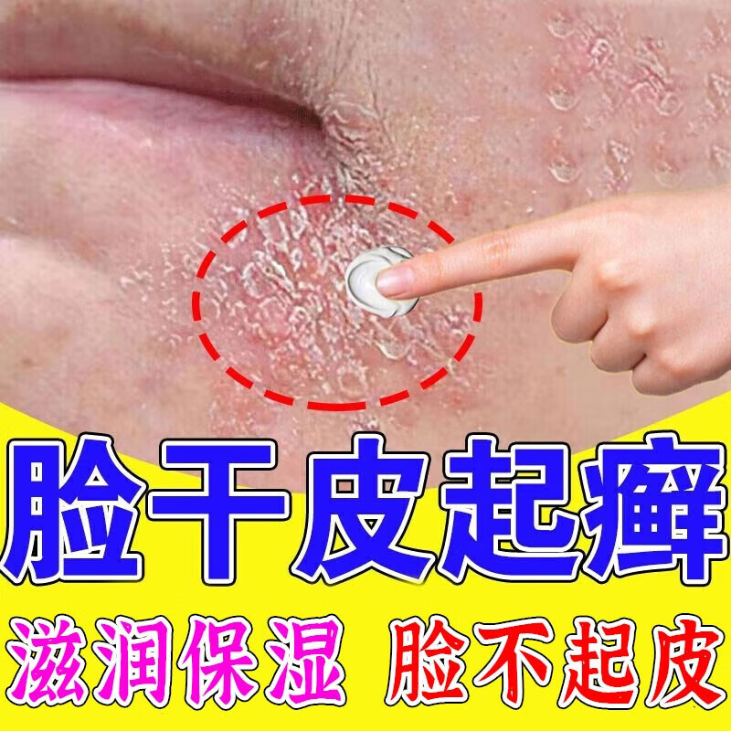 金力康脸上皮肤干燥起皮脸上起癣长癣眼癣脸干脱皮男女补水保湿修复霜