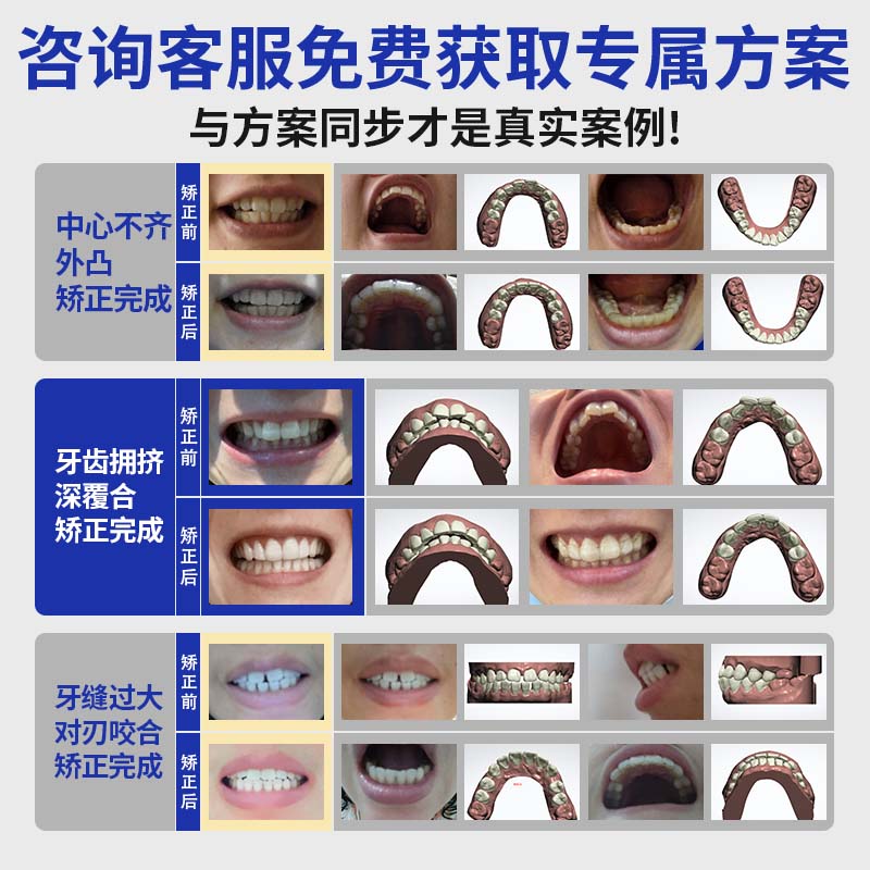 曙美（SHUMEI）正畸工具包隐形牙套牙齿矫正器保持器定制【免费提供矫正方案】 收货后联系我们教制做牙齿模