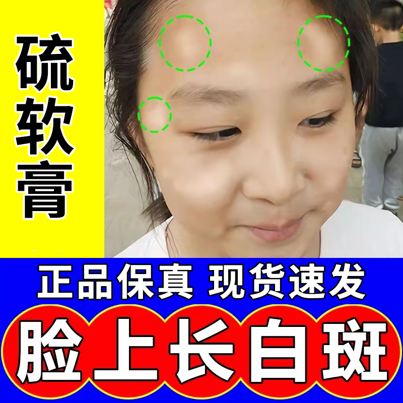 白色糠疹儿用药 药童膏 脸上白斑 脸上小圆形白斑白藓虫斑 脸上肩部