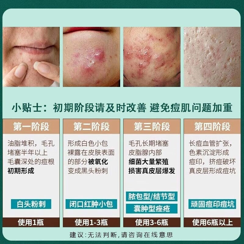 NHFOUYOU祛痘膏淡化痘印痘坑修复男女士改善粉刺闭口去痘痘和痘印 一盒【三盒一周期】买2盒 發3盒