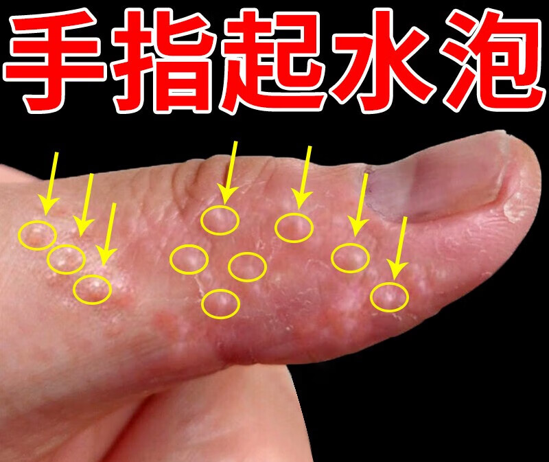 手上痒起小水泡专用膏手指缝瘙痒起泡真菌感染手脚脱皮干裂膏 1瓶体验