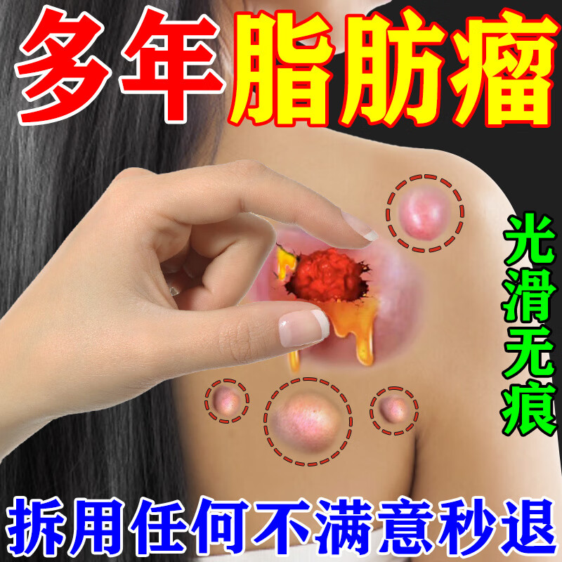 36种皮下多发性脂肪瘤去除膏全身皮脂腺囊肿脂肪瘤专用脂肪瘤去除神器