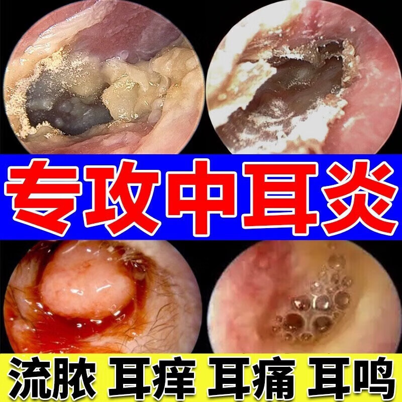 发炎流脓流水专用中耳炎滴耳液人用消炎耳朵痒痛耳痒滴耳液人用消非