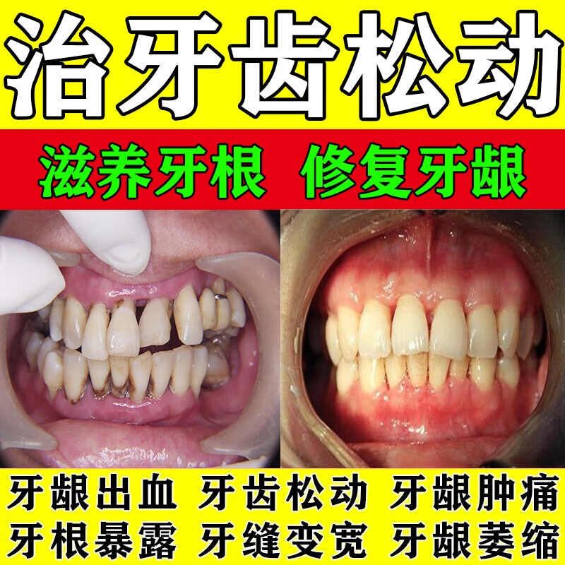 牙齿松动固齿修复牙龈萎缩肿痛出血牙根萎缩外露发黑牙齿松动牙根痛治