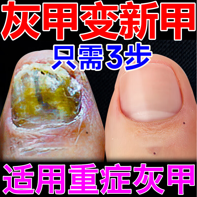 硝酸咪康唑乳膏 灰指甲药膏指甲真菌感染脱甲特药根 sos灰指甲治疗效