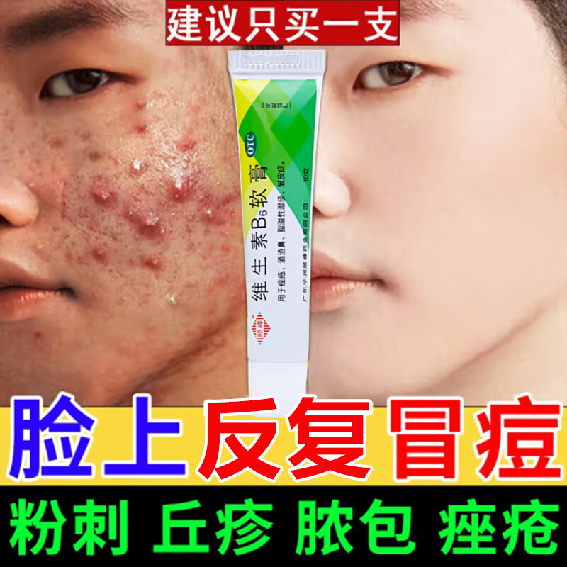维生素b6软膏 3盒【满下巴痘痘 瘙痒刺痛 一碰就疼】