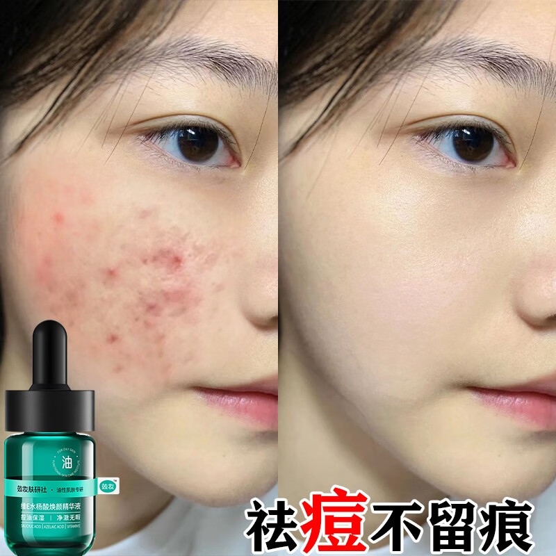 效妆水杨酸精华液壬二酸祛痘闭口修护痘印痘坑痘痘肌收缩毛孔男女学生 一瓶装/20毫升