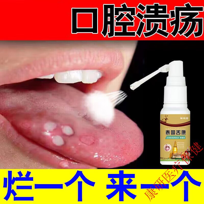 地图舌草莓舌黑舌苔口腔溃疡喷雾剂 念珠菌白斑黏膜红肿烂上火舌头