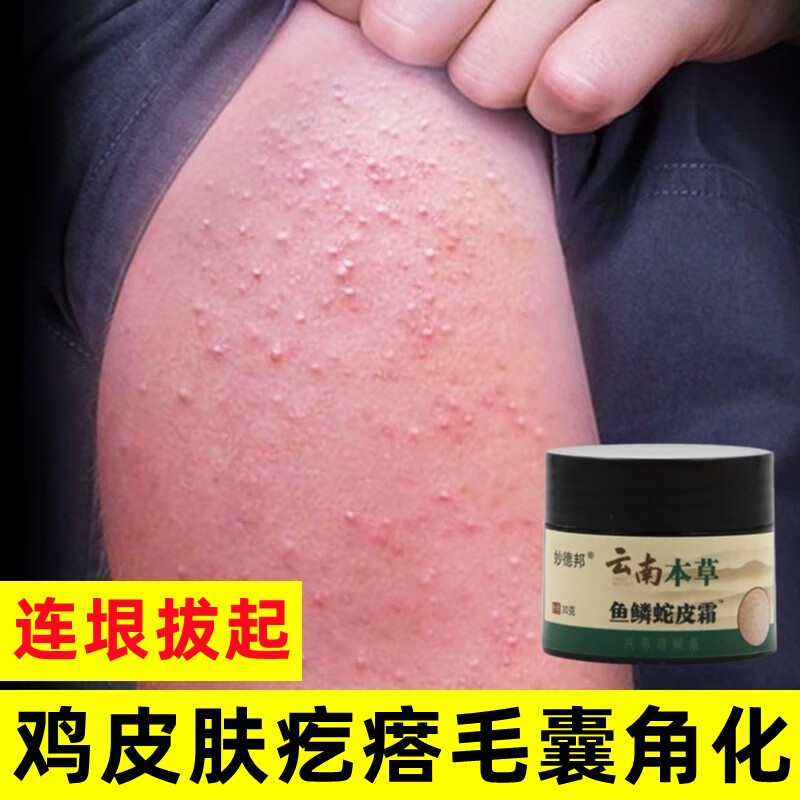 佰束胳膊上的小疙瘩鸡皮肤疙瘩毛囊角化毛周祛去除手