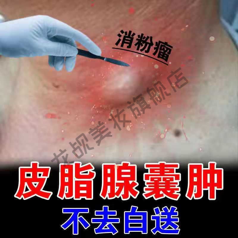 【急性子用】去粉瘤除皮脂腺囊肿疼痛皮下硬块脓包肿痛特孝专用膏粉瘤